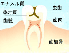 虫歯