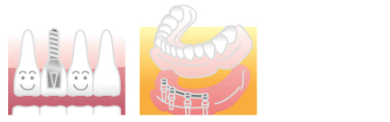 インプラント治療