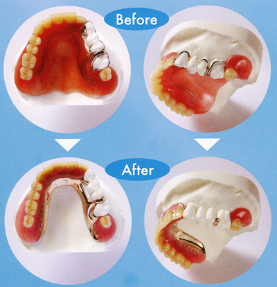 バネのない入れ歯