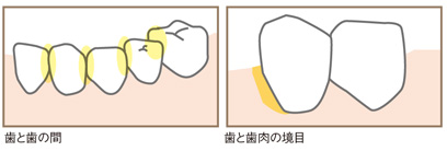 歯石、歯垢、茶渋を除去